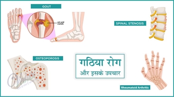 गठिया रोग और इसके उपचार