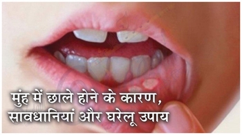 मुंह में छाले होने के कारण, सावधानियां और घरेलू उपाय