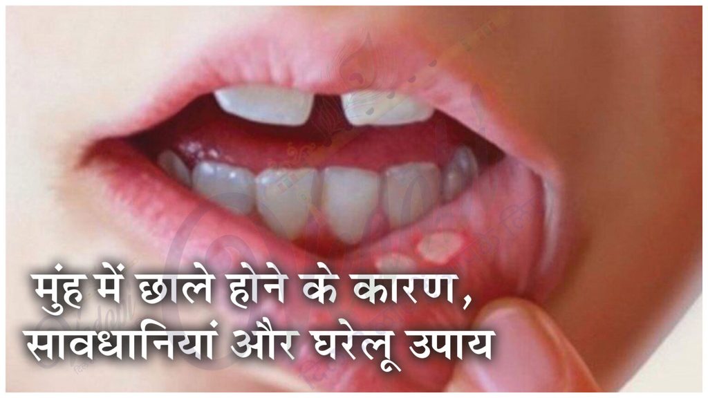 मुंह में छाले होने के कारण, सावधानियां और घरेलू उपाय