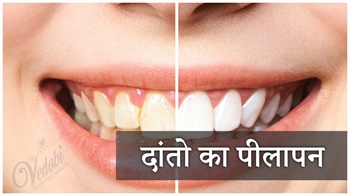 दांतो का पीलापन