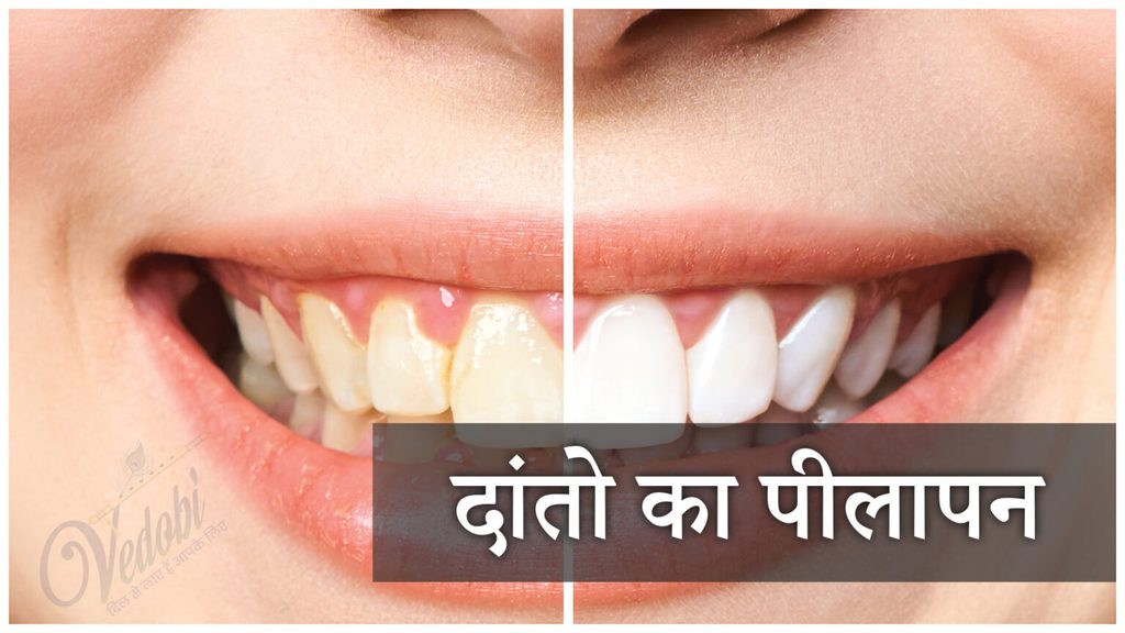 दांतो का पीलापन