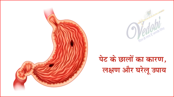 पेट के छालों का कारण, लक्षण और घरेलू उपाय