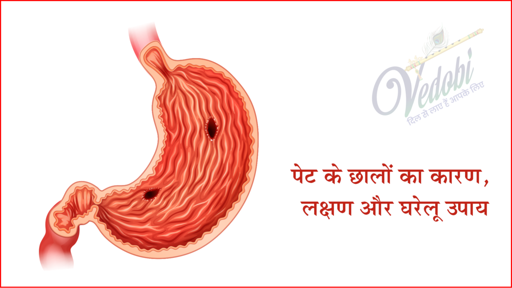 पेट के छालों का कारण, लक्षण और घरेलू उपाय