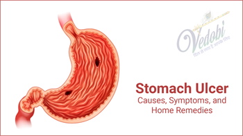 Stomach Ulcers: Causes, Symptoms and Home Remedies