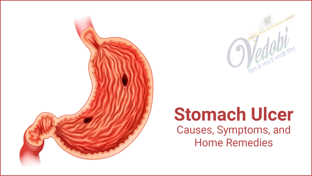 Stomach Ulcers: Causes, Symptoms and Home Remedies