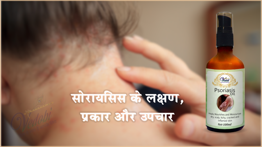 सोरायसिस के लक्षण, प्रकार और उपचार