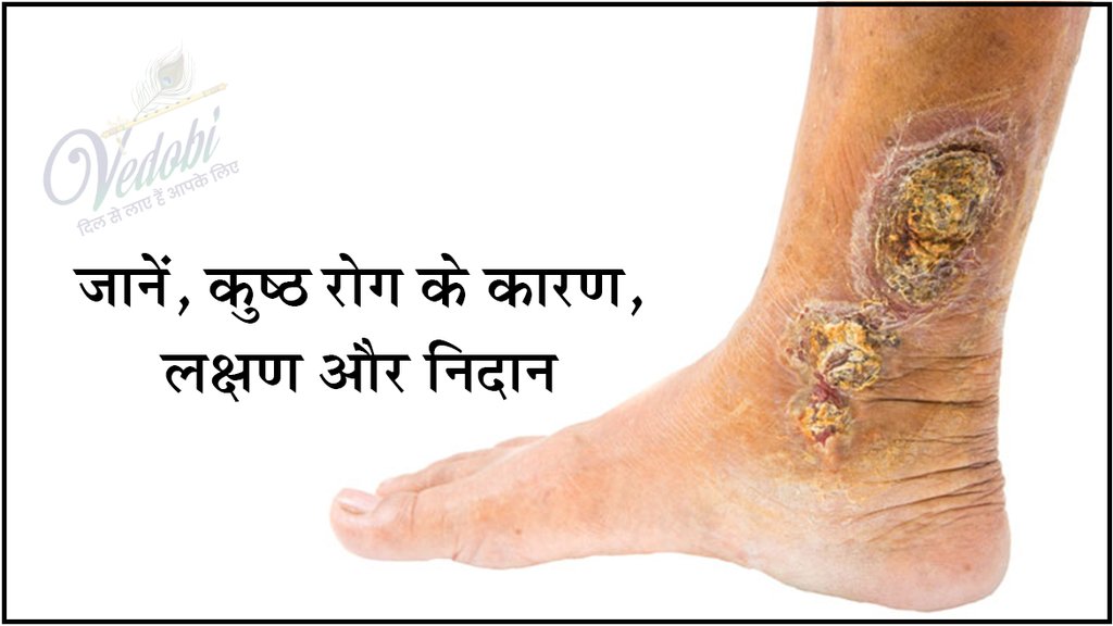 जानें, कुष्ठ रोग के कारण, लक्षण और निदान