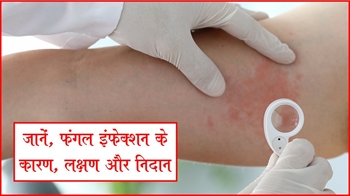 जानें, फंगल इंफेक्शन कारण, लक्षण और निदान