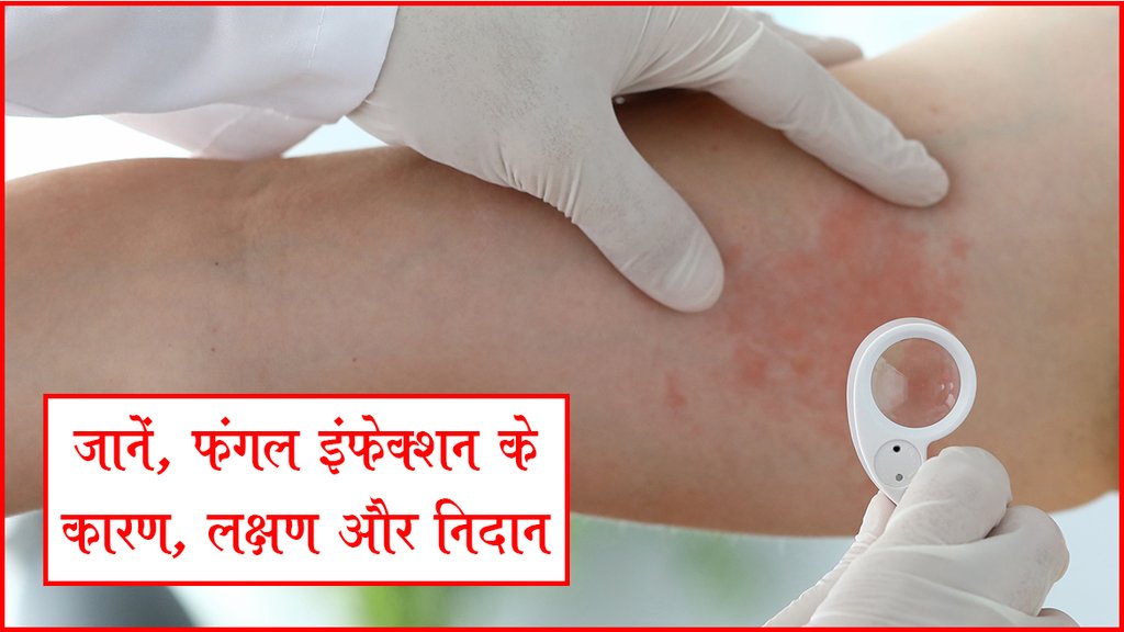 जानें, फंगल इंफेक्शन कारण, लक्षण और निदान