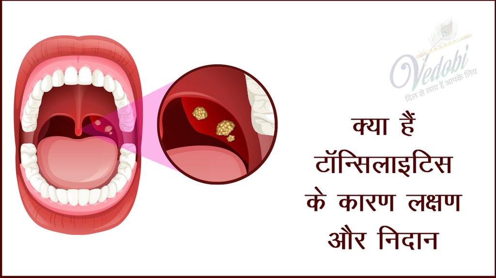 क्या हैं टॉन्सिलाइटिस के कारण लक्षण और निदान