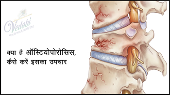 क्या है ऑस्टियोपोरोसिस, कैसे करे इसका उपचार?