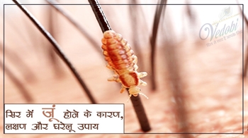 सिर में जूं होने के कारण, लक्षण और घरेलू उपाय