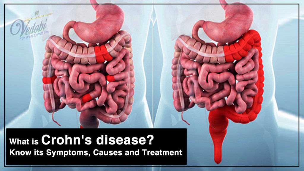 What is Crohn's disease? Know its Symptoms, Causes and Treatment