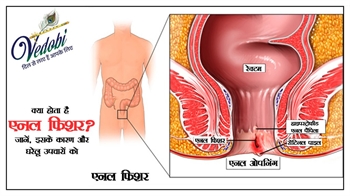 क्या होता है एनल फिशर? जानें, इसके कारण और घरेलू उपचारों को