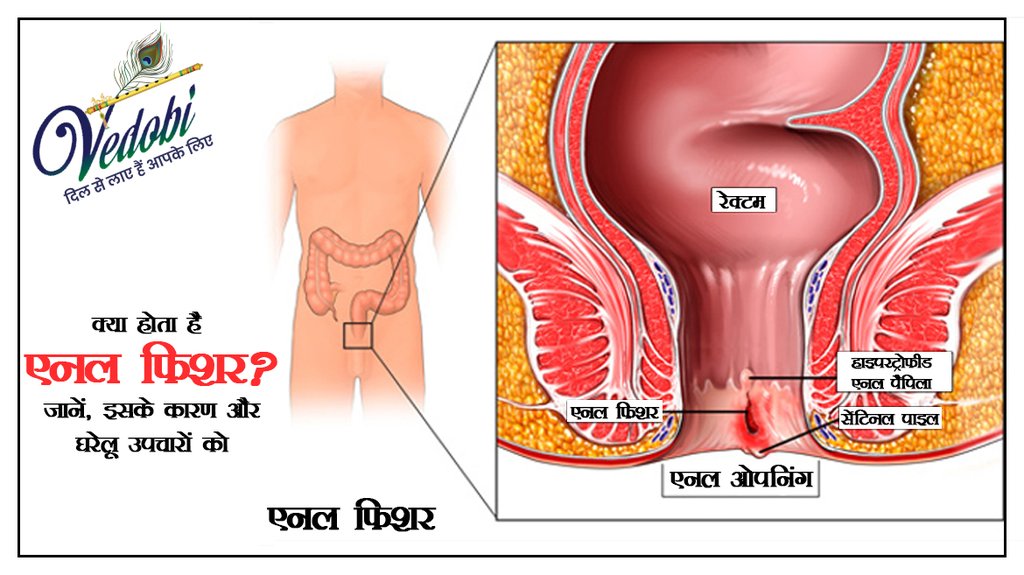 क्या होता है एनल फिशर? जानें, इसके कारण और घरेलू उपचारों को