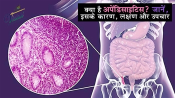 क्या है अपेंडिसाइटिस? जानें, इसके कारण, लक्षण और उपचार