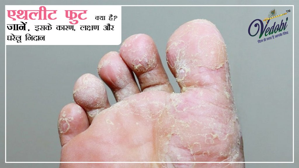 एथलीट फुट क्या है? जानें, इसके कारण, लक्षण और घरेलू निदान