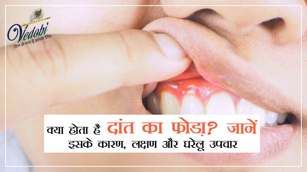 क्या होता है दांत का फोड़ा?जानें इसके कारण,लक्षण और घरेलू उपचार