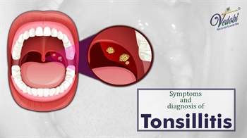 Symptoms and Diagnosis of Tonsillitis