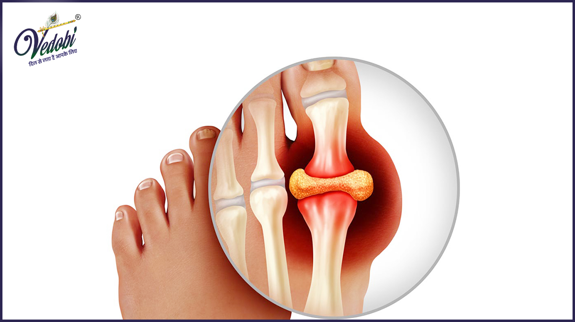 Gout: What is it, Symptoms, Causes and Treatment