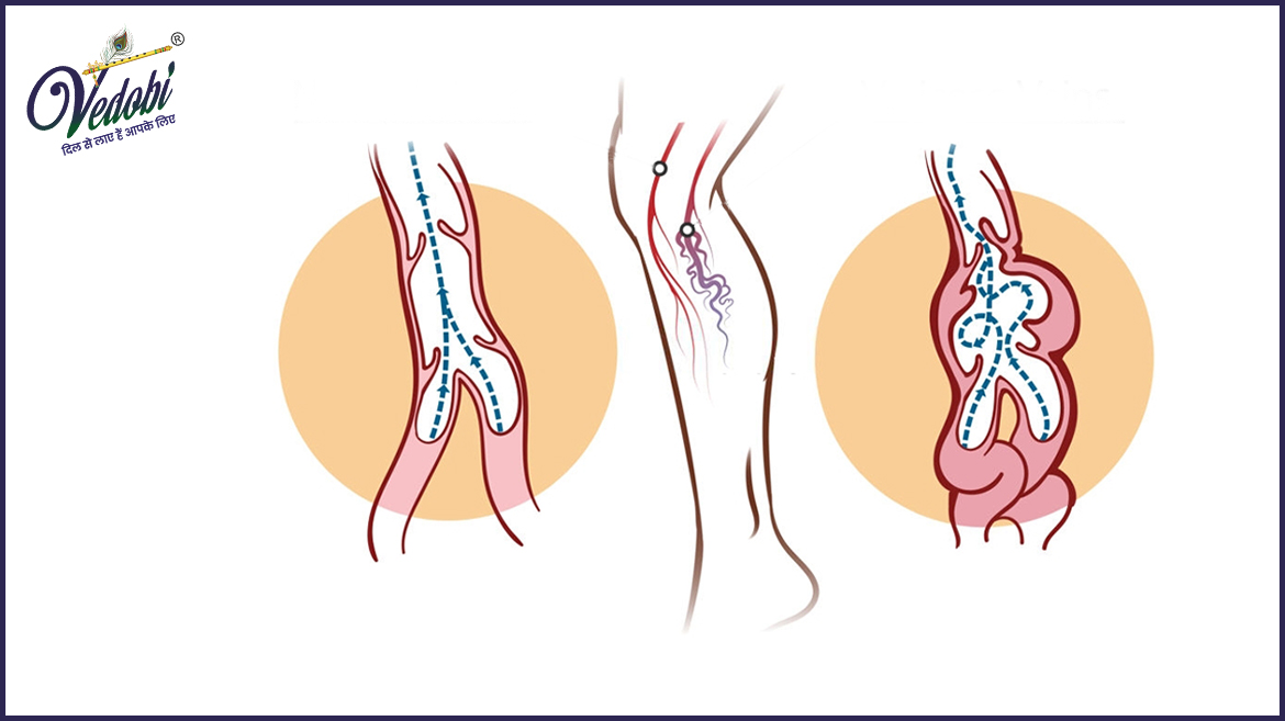वैरिकोज नसें (veins) क्या है? जानें, इसके कारण, लक्षण और घरेलू उपाय