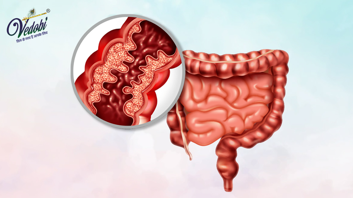 Symptoms and Home Remedies for Inflammatory Bowel Disease (IBD)