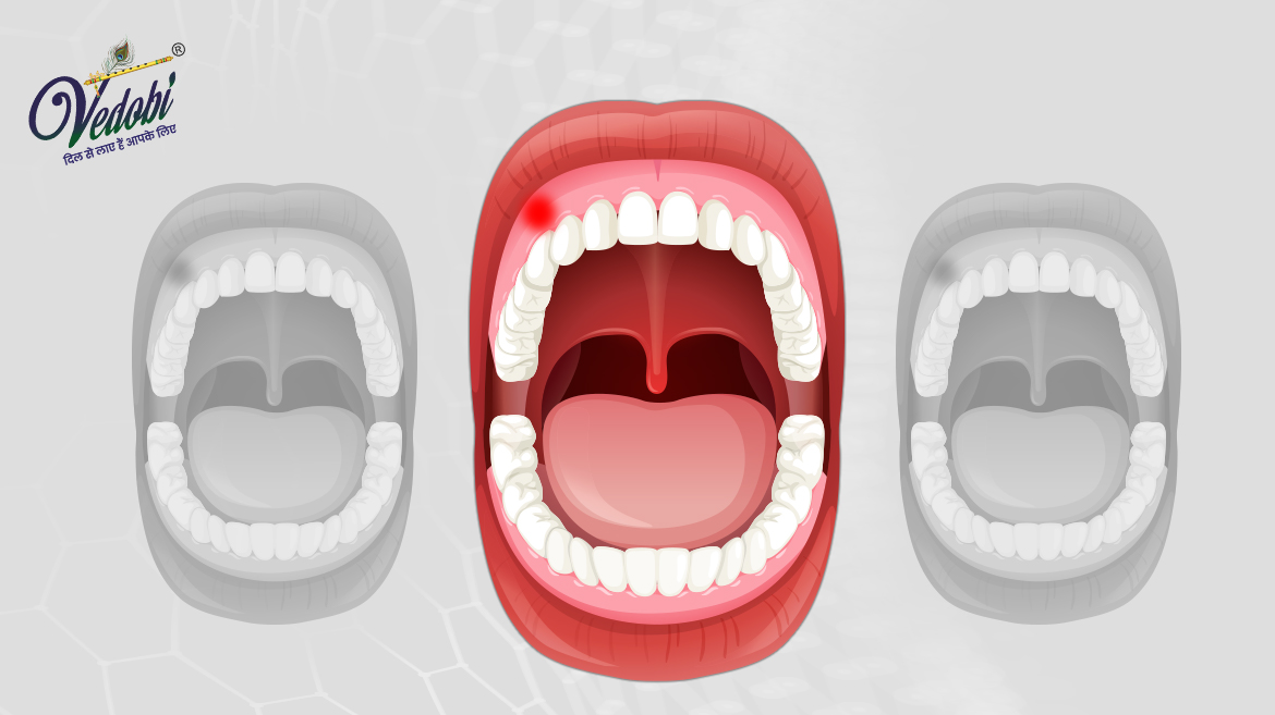 What is a Tooth abscess? Know its Causes, Symptoms and Home remedies