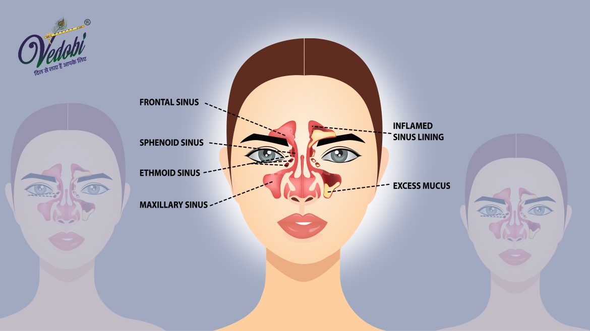 Sinusitis: Causes, Symptoms and Home remedies