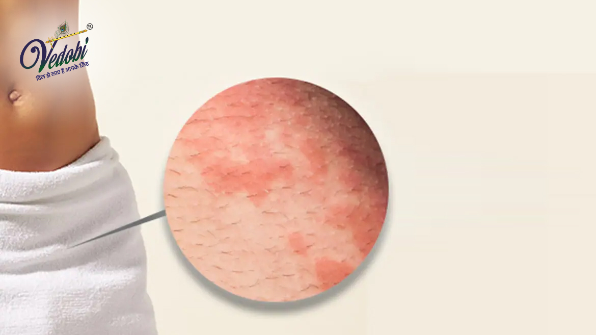 जॉक इच का क्या कारण है? जानिए इसके लक्षण और इलाज के बारे में