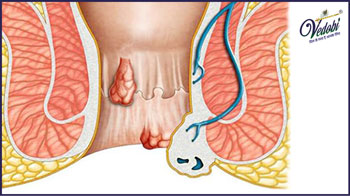 बवासीर क्या है? जानें, इसके प्रकार, कारण, लक्षण और घरेलू उपचार