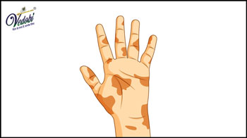 Know the Causes, Symptoms and Diagnosis of Leprosy