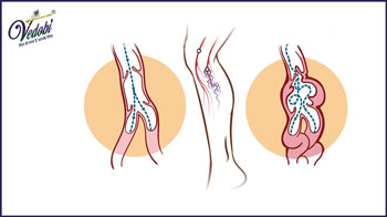 वैरिकोज नसें (veins) क्या है? जानें, इसके कारण, लक्षण और घरेलू उपाय