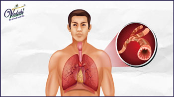 What is Achalasia? Know its Symptoms, Causes and Home remedies