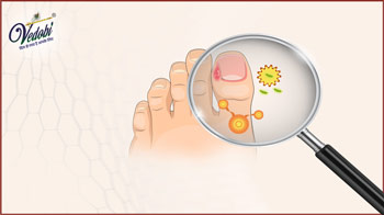 What causes Jock Itch? Know about its Symptoms & Treatment