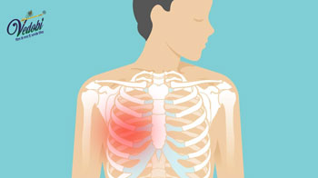 Costochondritis: Symptoms, Causes & Treatment