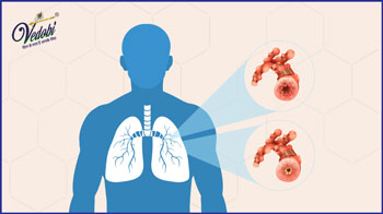 Emphysema: Causes, Symptoms and Treatment