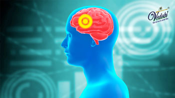 Aneurysm: Causes, Symptoms, Diagnosis and Treatment