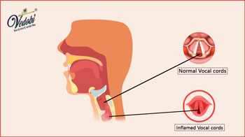 Laryngitis: Everything You Need To Know