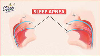 Sleep Apnea: Types, Symptoms, Causes and Treatment