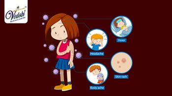 Monkeypox- A Rare Viral Disease