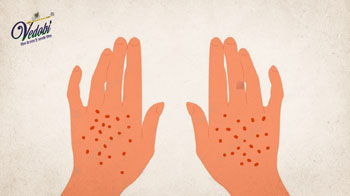 Porphyria: Symptoms, Causes and Treatment