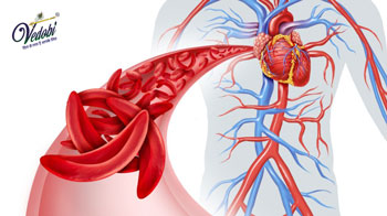 Atherosclerosis Symptoms, Causes, Diagnosis and Treatment