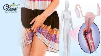 What is a Candidal Infection? Know its Causes, Symptoms, and Home remedies