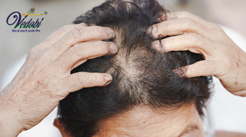 Baldness: Causes, Symptoms and Treatment