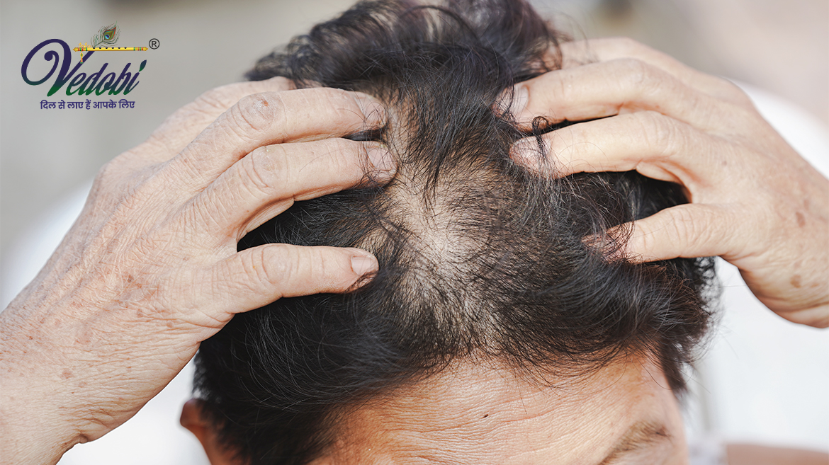 Baldness: Causes, Symptoms and Treatment