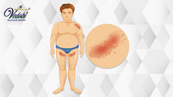 What is Chancroid? Know its Causes and Symptoms