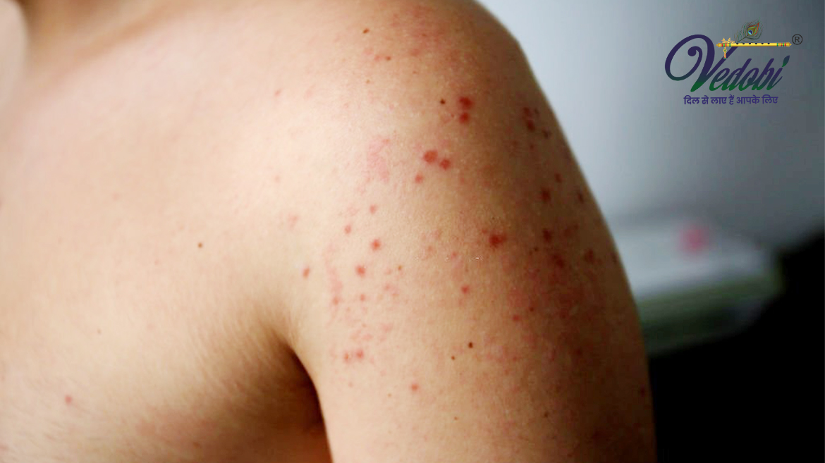 खसरा रोग के कारण, लक्षण और उपचार