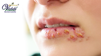 Cold Sores- Know its Symptoms & Treatment