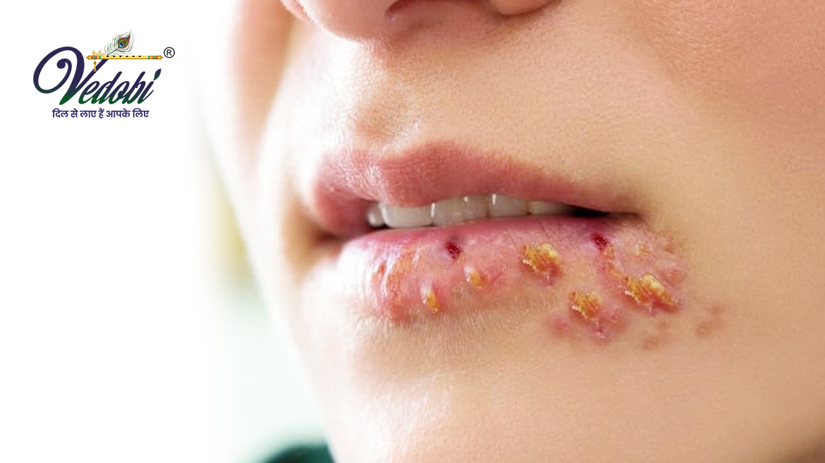 Cold Sores- Know its Symptoms & Treatment