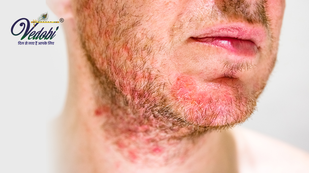 Folliculitis- Causes, Symptoms and Treatment